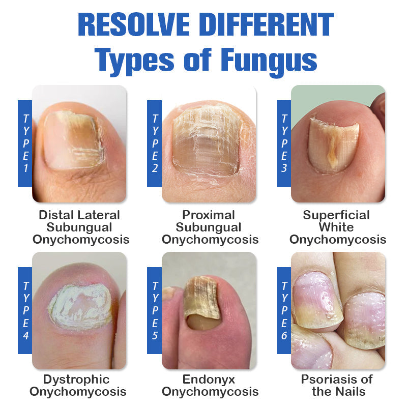 (🔥LIMITED DISCOUNT 70% - UTOLSÓ NAP🔥)Furzero ™ Lézeres körömgomba eltávolító készülék🔥