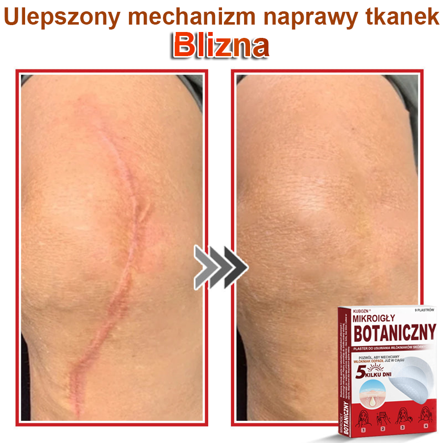 KUBOZN® Mikroigłowy botaniczny środek do usuwania narośli skórnych ✅✅wyprodukowano w Polsce