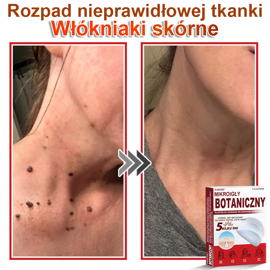 KUBOZN® Mikroigłowy botaniczny środek do usuwania narośli skórnych ✅✅wyprodukowano w Polsce