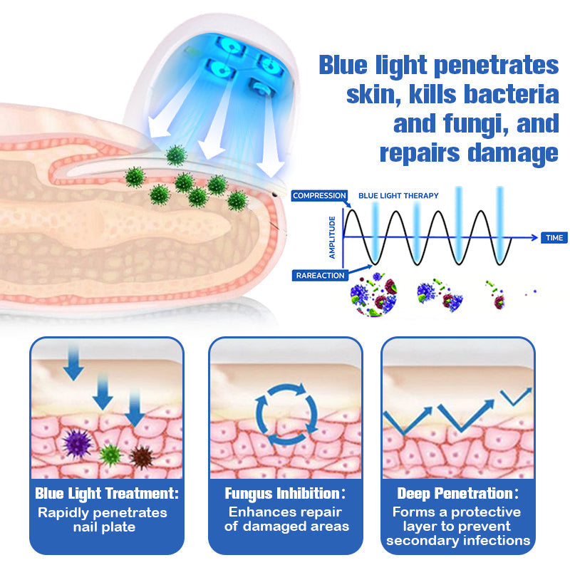 (🔥LIMITED DISCOUNT 70% - UTOLSÓ NAP🔥)Furzero ™ Lézeres körömgomba eltávolító készülék🔥