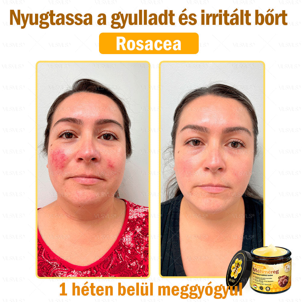 💪💪💪VLSVLS® Méhméreg Bőrhelyreállító Krém (👨⚕CE jóváhagyott)👍✅