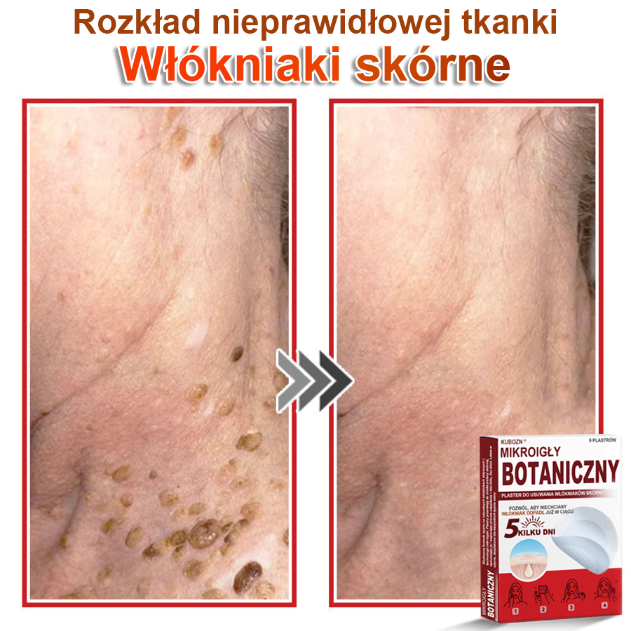 KUBOZN® Mikroigłowy botaniczny środek do usuwania narośli skórnych ✅✅wyprodukowano w Polsce