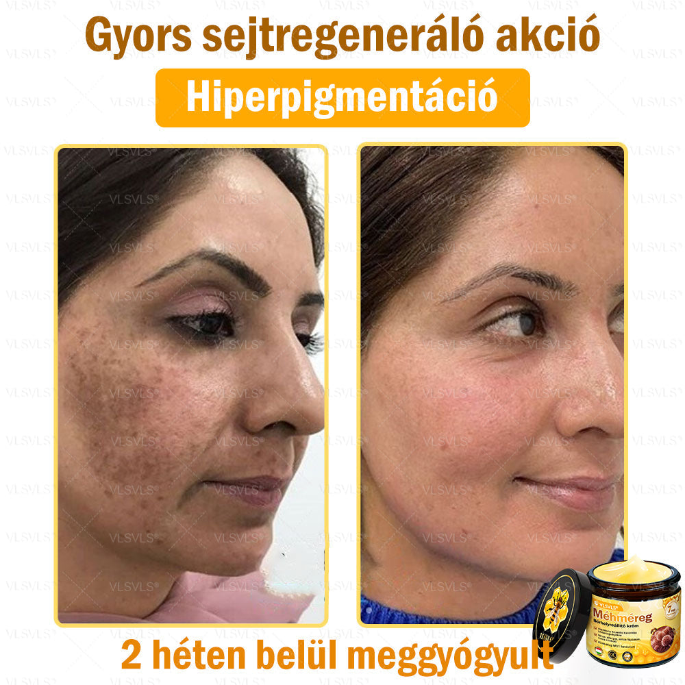 💪💪💪VLSVLS® Méhméreg Bőrhelyreállító Krém (👨⚕CE jóváhagyott)👍✅