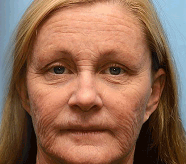 (🌿🌿Készült és szállított az EU-ból✅)  - 👩⚕️Furzero™ Botox méhméreg ránctalanító krém-(UTOLSÓ NAP 70% LE)