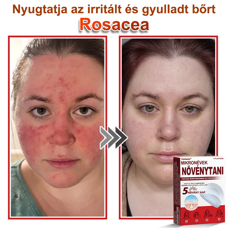 Voilaist® Mikro-tűs botanikai bőrnövedék-eltávolító ✅✅Készült Magyarországon