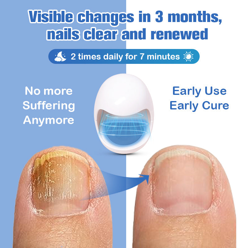 (🔥LIMITED DISCOUNT 70% - UTOLSÓ NAP🔥)Furzero ™ Lézeres körömgomba eltávolító készülék🔥