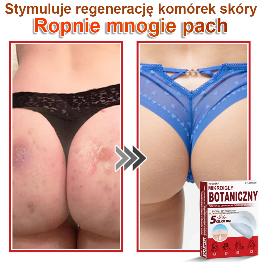 KUBOZN® Mikroigłowy botaniczny środek do usuwania narośli skórnych ✅✅wyprodukowano w Polsce