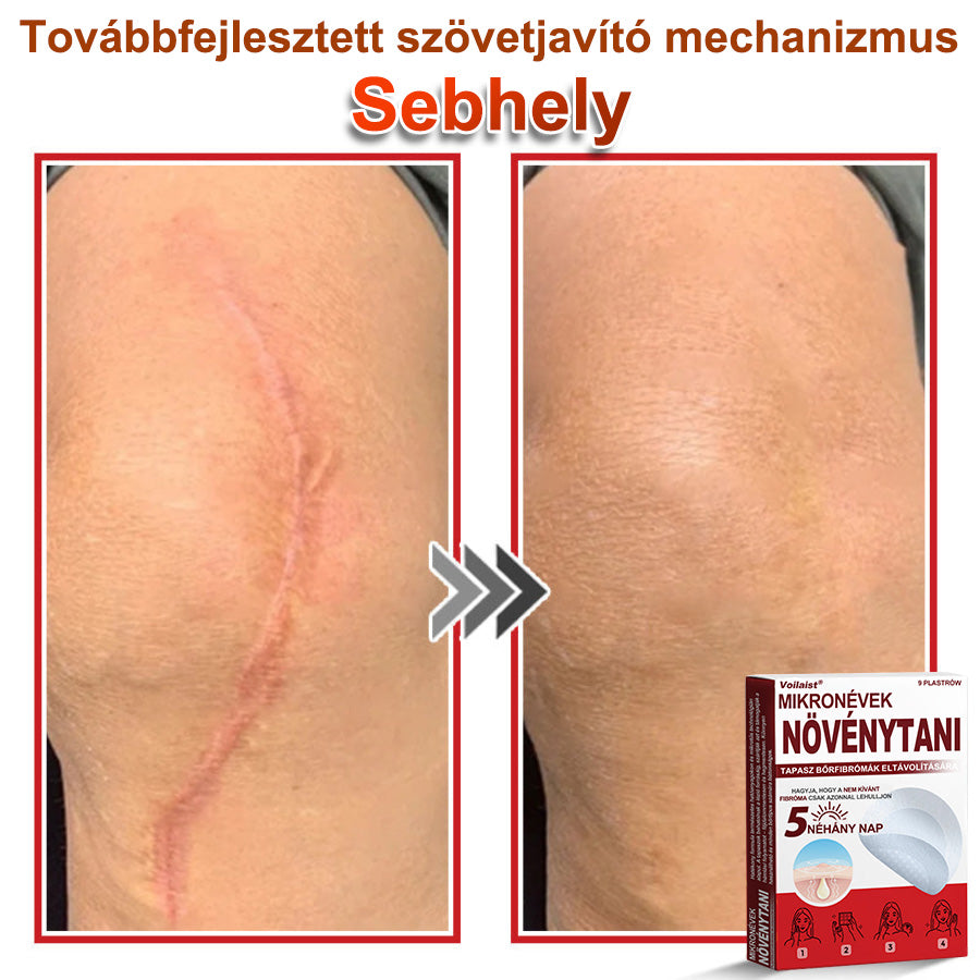 Voilaist® Mikro-tűs botanikai bőrnövedék-eltávolító ✅✅Készült Magyarországon