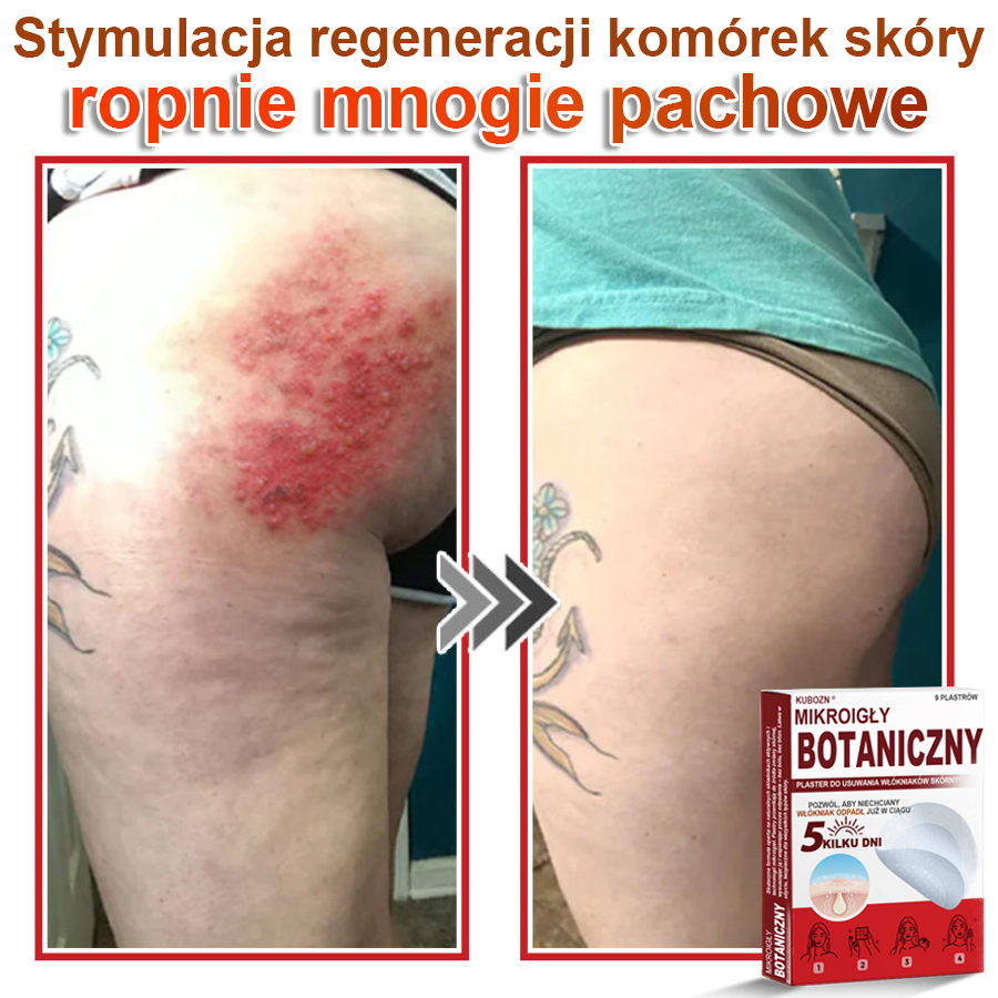 KUBOZN® Mikroigłowy botaniczny środek do usuwania narośli skórnych ✅✅wyprodukowano w Polsce