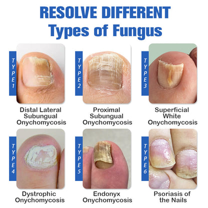 (🔥LIMITED DISCOUNT 70% - UTOLSÓ NAP🔥)Furzero ™ Lézeres körömgomba eltávolító készülék🔥