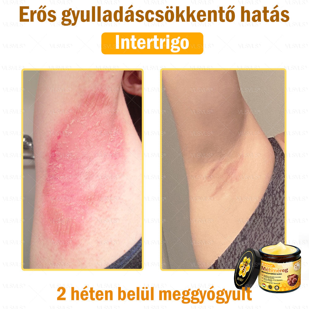 💪💪💪VLSVLS® Méhméreg Bőrhelyreállító Krém (👨‍⚕‍CE jóváhagyott)👍✅