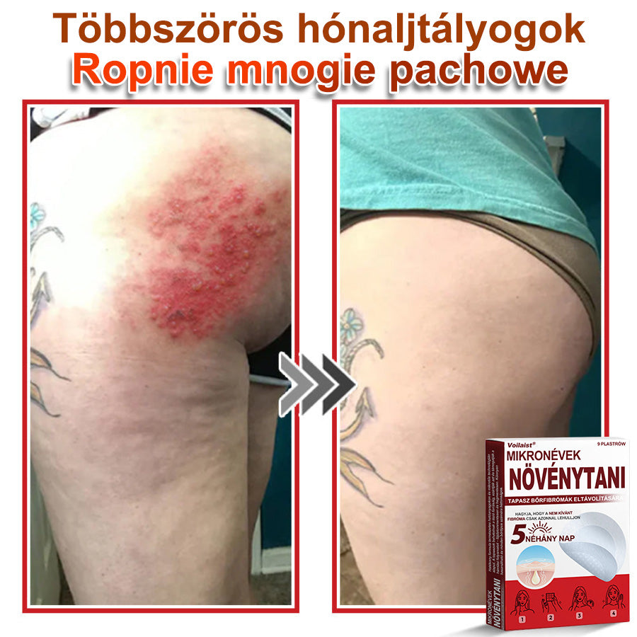 Voilaist® Mikro-tűs botanikai bőrnövedék-eltávolító ✅✅Készült Magyarországon