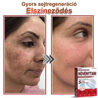 Voilaist® Mikro-tűs botanikai bőrnövedék-eltávolító ✅✅Készült Magyarországon