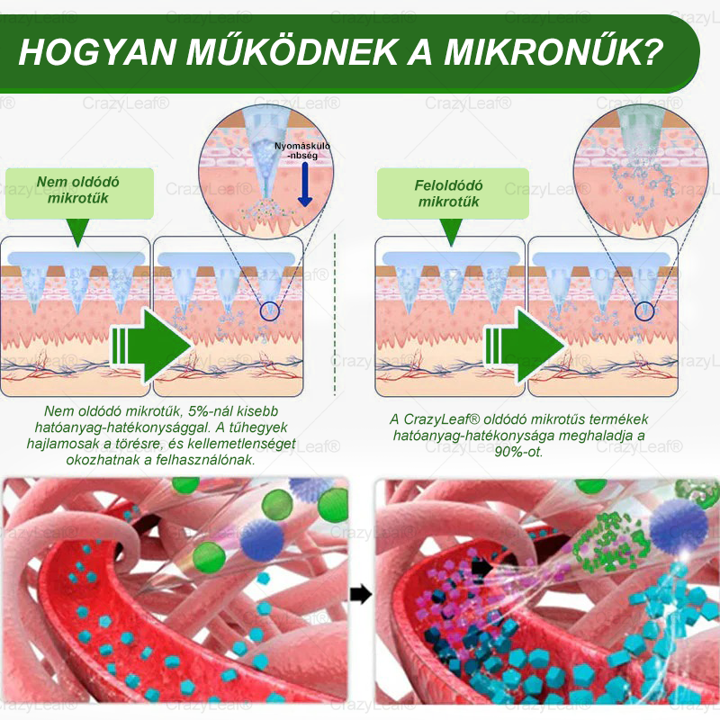 🔥│Hivatalos webáruház│🌿 CrazyLeaf® SMGT-GLP-1 Nano Mikrotűs Tapasz 👉Természetes segítség túlsúly, fáradtság, bőr- és ízületi problémák ellen.