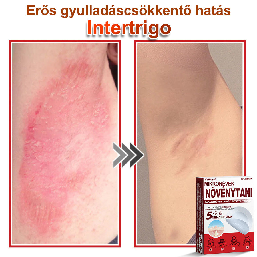 Voilaist® Mikro-tűs botanikai bőrnövedék-eltávolító ✅✅Készült Magyarországon