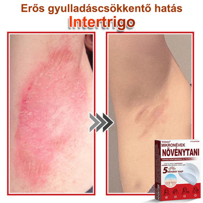 Voilaist® Mikro-tűs botanikai bőrnövedék-eltávolító ✅✅Készült Magyarországon