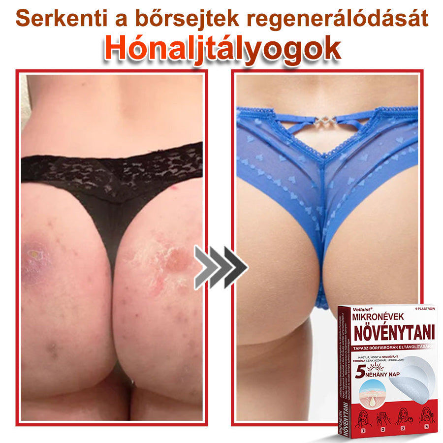 Voilaist® Mikro-tűs botanikai bőrnövedék-eltávolító ✅✅Készült Magyarországon