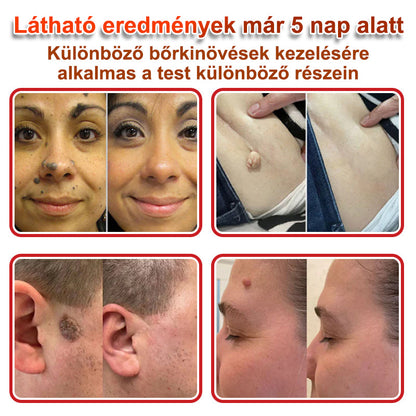 Voilaist® Mikro-tűs botanikai bőrnövedék-eltávolító ✅✅Készült Magyarországon