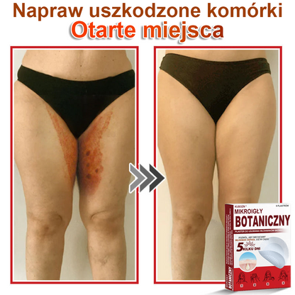 KUBOZN® Mikroigłowy botaniczny środek do usuwania narośli skórnych ✅✅wyprodukowano w Polsce