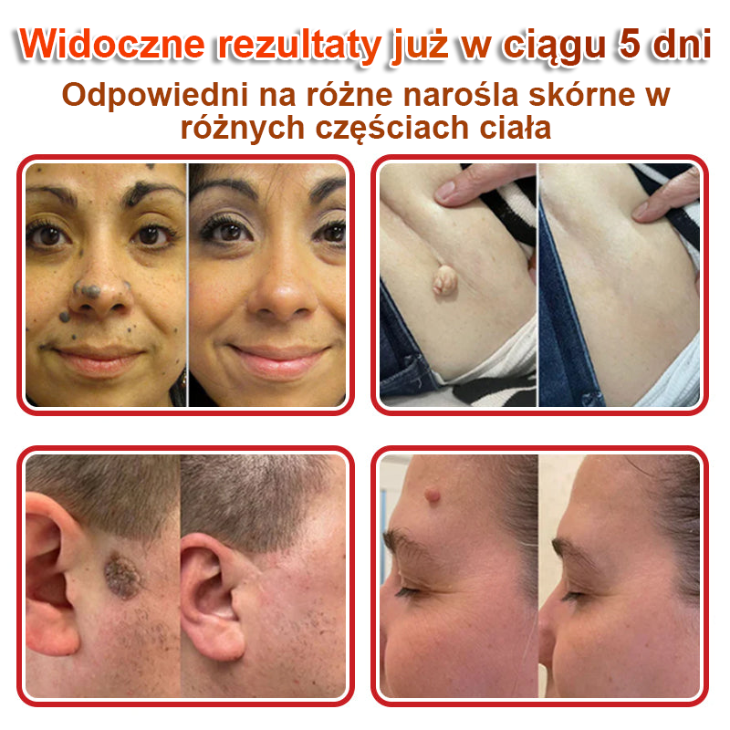 KUBOZN® Mikroigłowy botaniczny środek do usuwania narośli skórnych ✅✅wyprodukowano w Polsce