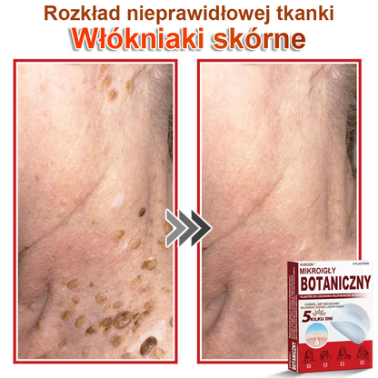 KUBOZN® Mikroigłowy botaniczny środek do usuwania narośli skórnych ✅✅wyprodukowano w Polsce